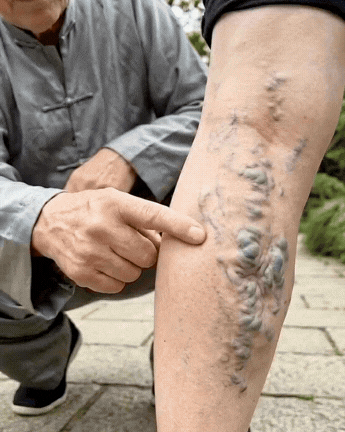 Crema per vene varicose